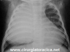 Fig. 1: RX de tórax com opacidade em pulmão direito