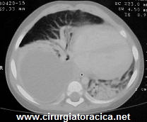 Fig. 2: RX de tórax com opacidade em pulmão direito