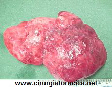 Fig. 4: peça cirúrgica: lobo superior direito