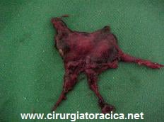 Fig. 4: Peça cirúrgica (timo)