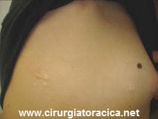 Fig. 5: Aspecto das cicatrizes cirúrgicas 2 anos após o procedimento
