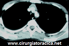 Fig. 1: Tomografia de tórax demonstrando mínimo aumento de timo
