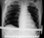 Pós-operatório de  pectus excavatum após tratamento com barra de Nuss