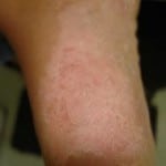 Paciente com pés descamativos após a cirurgia para hiperidrose plantar