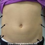 Locais das incisões na simpatectomia lombar bilateral