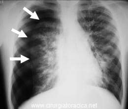 Pneumotórax de pulmão direito em paciente com fibrose cística (indicado pelas setas)