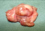 segmento pulmonar (ápice) com bolha rota